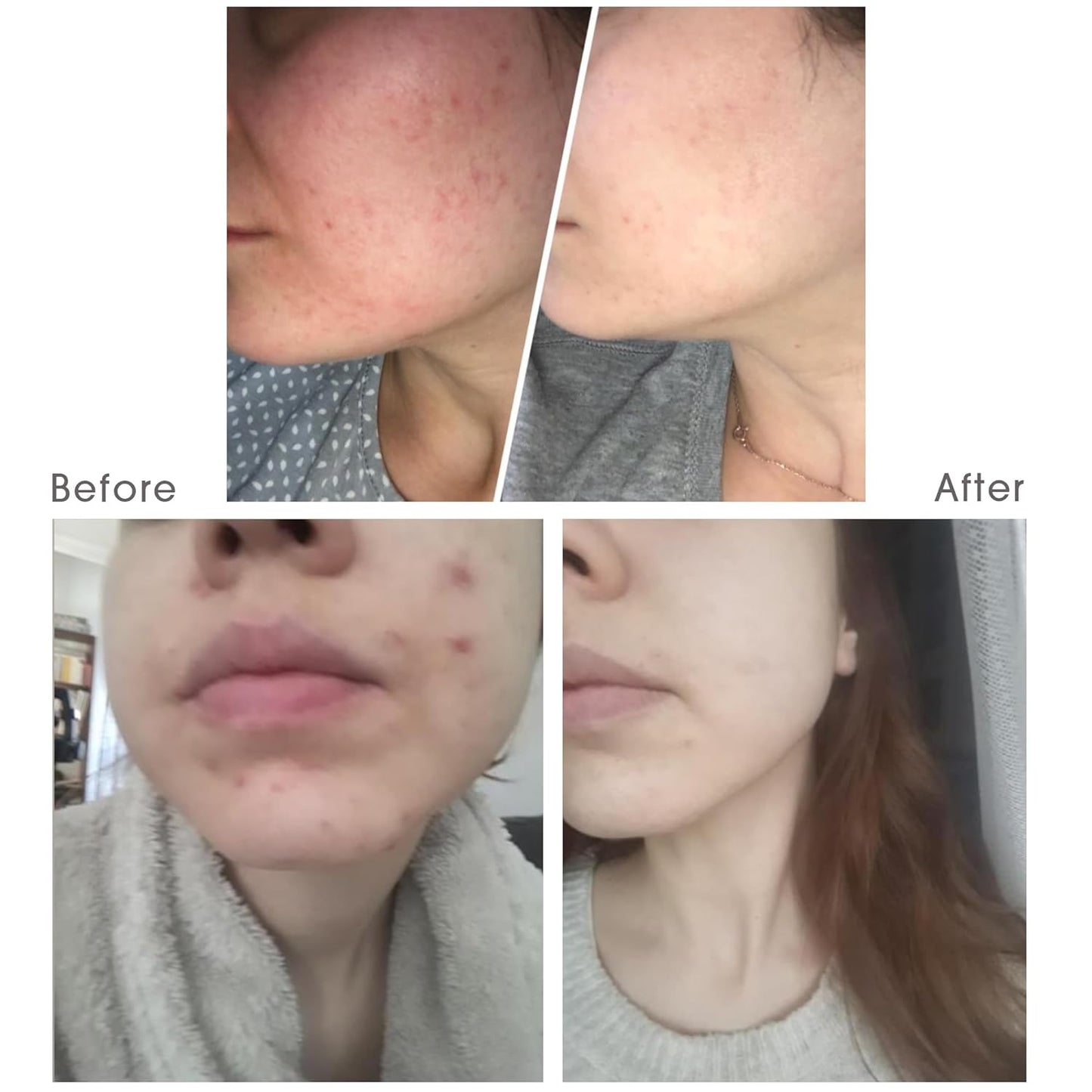 BENTONITE CLAY FACIAL MASK - 100% Natural - Purifying, Anti-acne, Anti-pore, Deep Detox